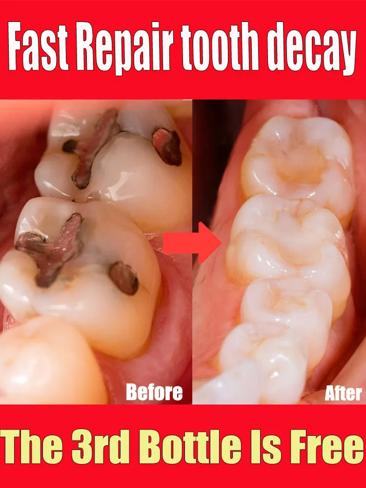 Repair Tooth Decay ALL Cavities