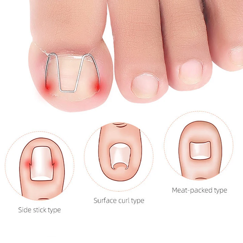 

Nail Art Ingrown Toe Nail Correction Tool Toenail Nail Orthosis Paronychia Clip
