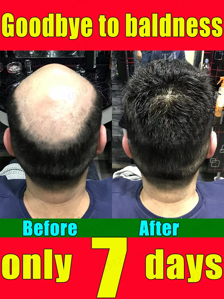 

Provide nutrition for baldness and grow new hair