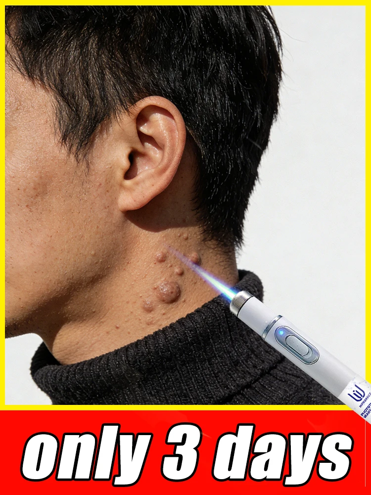 Quickly Remove Warts 2026 Solve Your Troubles Stubborn Wart Removal for Feet And Body