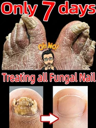 Fungus Nails Fungal Nail Repair Szybki grzybica paznokci