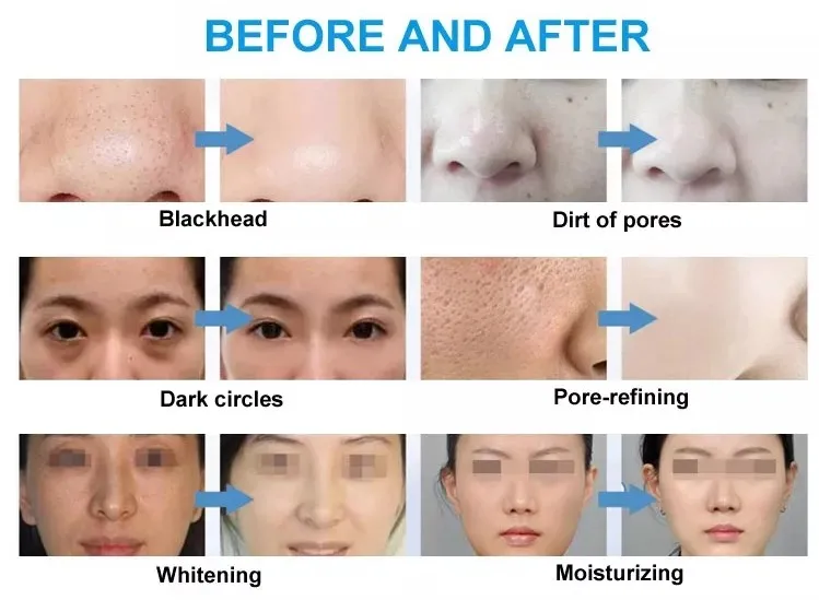 7 في 1 تقشير المياه اللوازم الطبية آلة تجديد الجلد المياه الأكسجين جلدي تحليل جمال الوجه الجلد #1