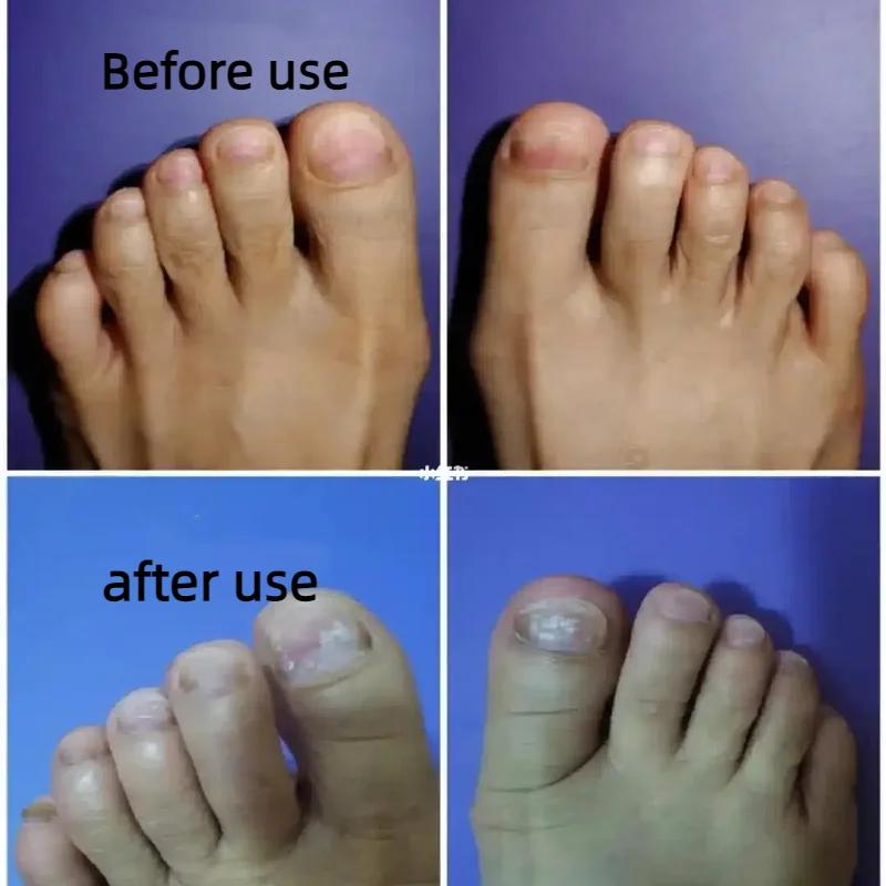 

905nm Laser Nail Fungus Treatment Equipment, Home Use Toenail Care Device, Effective Removal & Prevention