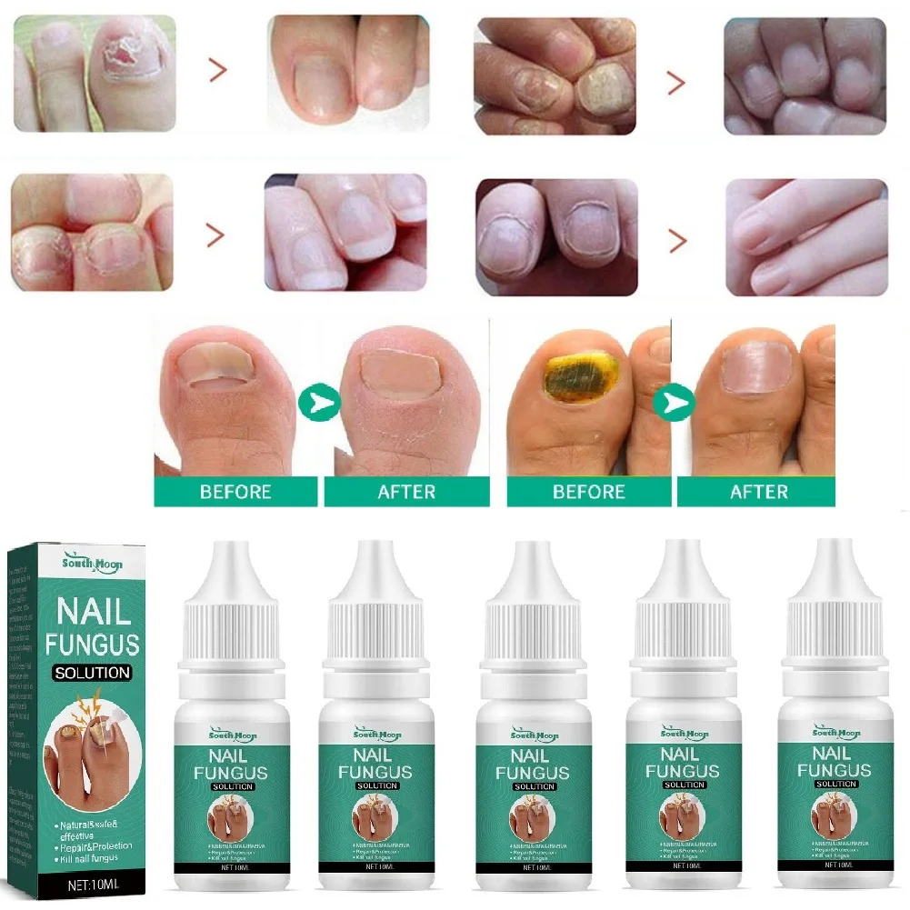 5Pcs Extra Starke Nagel Pilz Behandlung Serum Essenz Pflege Reparatur Essenz Anti Zehen Infektion Gel Füße Serum Entfernung Nägel pilz