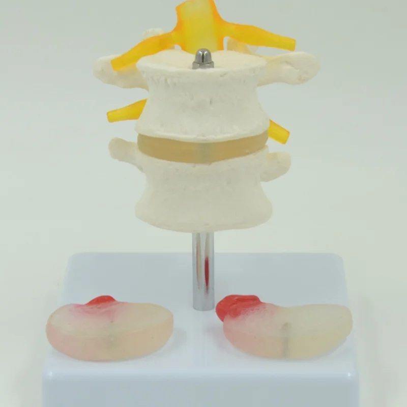 DARHMMY  Human Lumbar Model With 2 Diseased Intervertebral Discs Spinal Nerve Roots Skeletal Anatomy, Medical Teaching Display