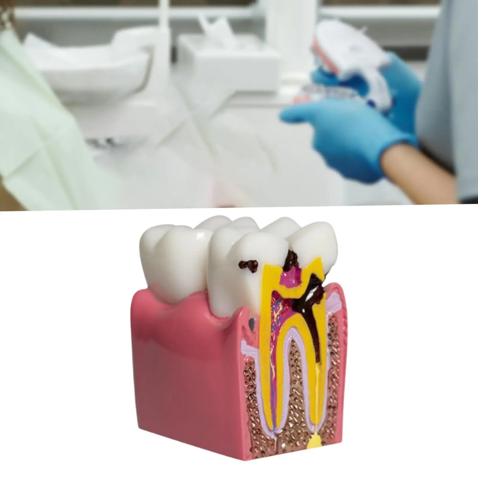 6 Times Caries Tooth Model Resin Dental Structure Teaching Aid for Early Childhood Education Family Learning and Classroom