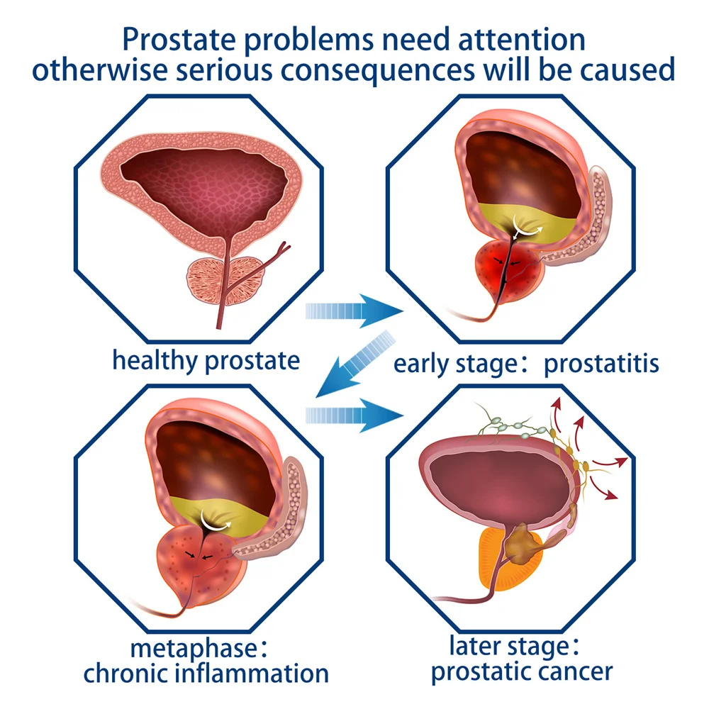 Prostatic Navel Plaster Treatment Patches Man Prostatic Navel Medical Plaster Strengthen Kidney Herbs Patch Relief Urethritis