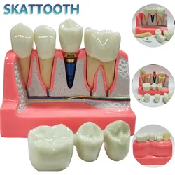 Dental Implant Teach Crown Bridge Removable Model Porcelain Teeth Model Dental Demonstration Model for Dentist Teaching