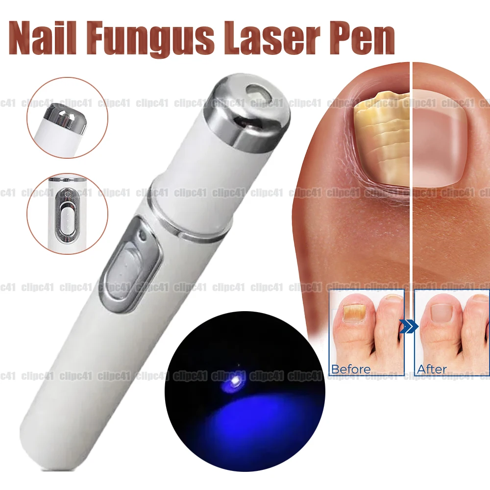 Stylo Laser pour traitement des champignons des ongles, Anti-Infection fongique, élimine les dissipations, liquide pour l'onychomycose, réparation des ongles des orteils, soins des pieds