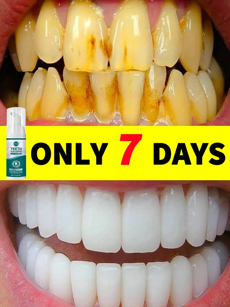 

Tartar removers dissolve tartar and remove stains dental calculus removal in just 7 days