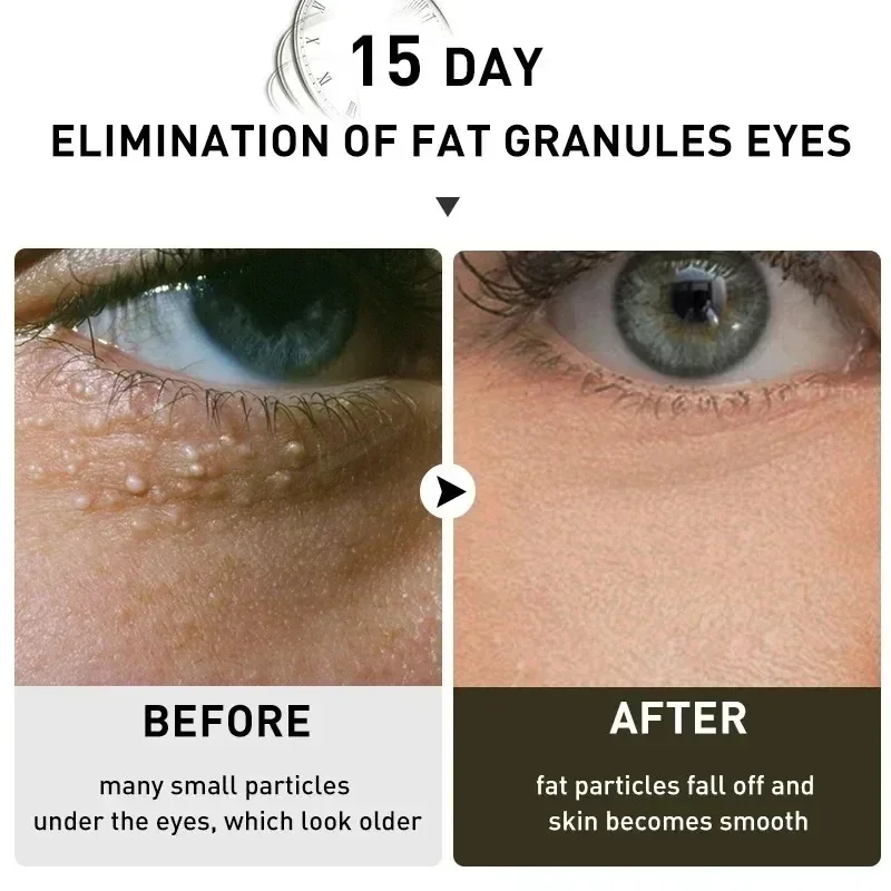 Fat Granules Remover Eye Cream Anti-Puffiness Firm Cream Anti Inflammatory Fade Fine Line Repair Skin Barrier Korean Skin Care