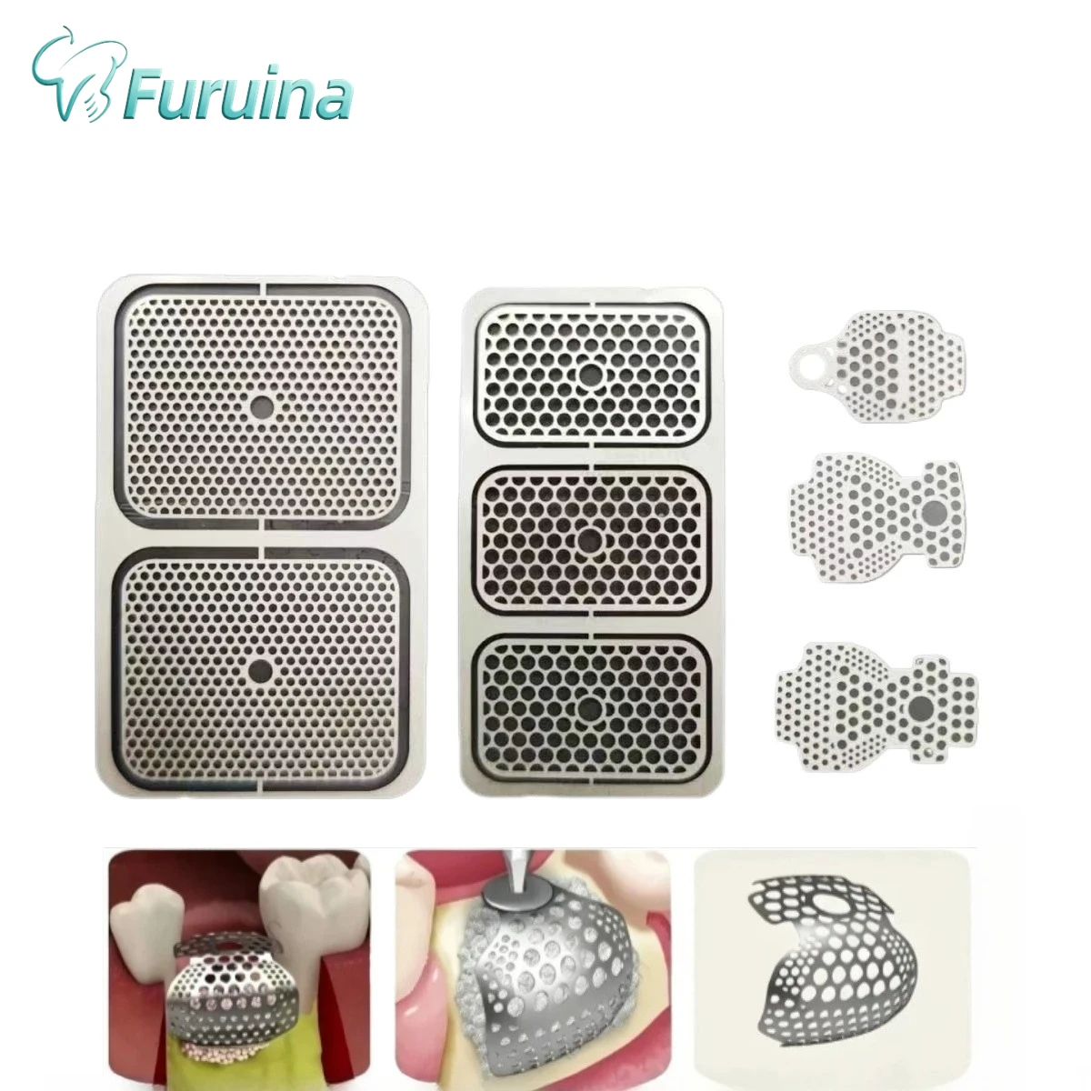 

Dental OB2 3D Titanium Mesh for GBR Guided Bone Regeneration Membrane Plate Implant Formation Incremental SmartBuilder