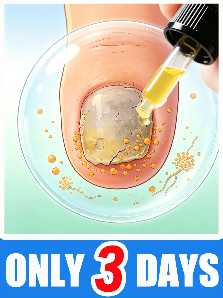 Foot care for fungal nail infections, effectively inhibiting fungal recurrence.