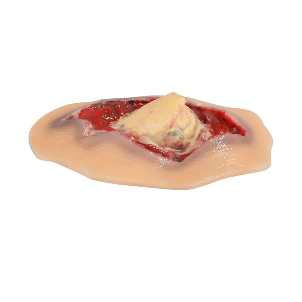 Ultrassist Ankle Fracture Wound Moulage Self-Adhesive Silicone Model Injury Simulator Exposed Bone & Torn Flesh for Medic Train