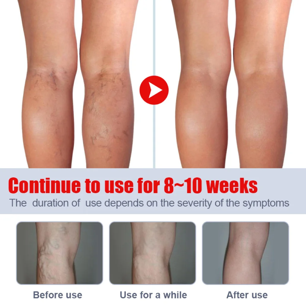 Varicose Vein Treatments Cream Effective Relieve Legs Dilated Vasculitis Phlebitis Spider Legs Natural Formula Ointment