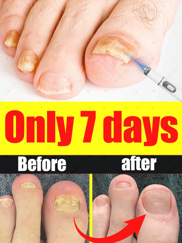 

Blue laser care manicure