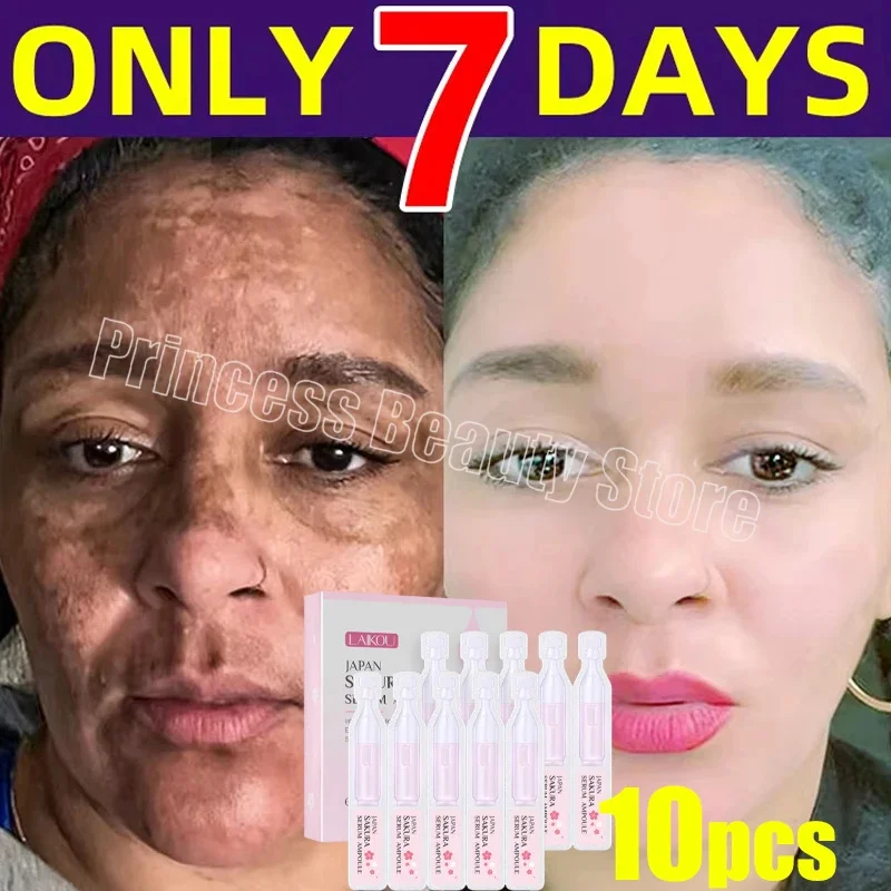 

Whitening Freckle Face Serum Remove Melasma Dark Spot Lightening Melanin Brighten Melasma Anti-Aging Essence Skin Care Product