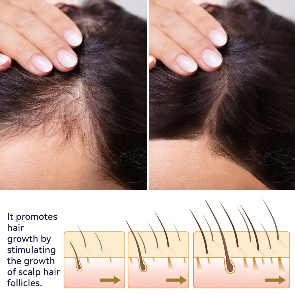 Tratamiento de folículo piloso para el crecimiento rápido del cabello, Alopecia seborreica, línea capilar hacia arriba, pérdida de cabello posparto, calvicie, pérdida de cabello