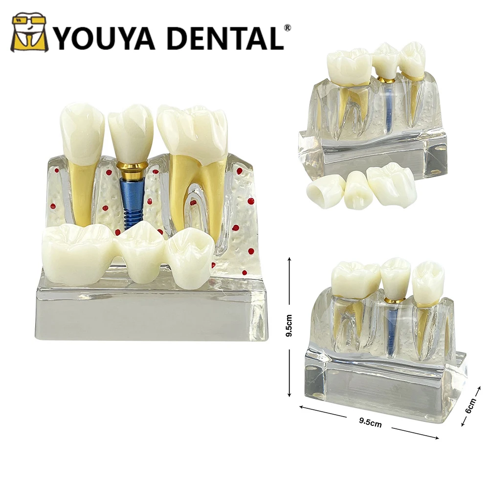 

Dental 4 Times Implant Teeth Teaching Model for Dentist Student Practice Studying Training Doctor-patient Communication Tools