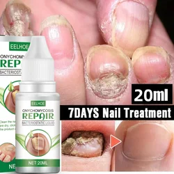 Nail Fungus Treatment Serum Toe Fungal Repair Products Hand Foot Care Removal Gel Anti Infection Onychomycosis Paronychia Care