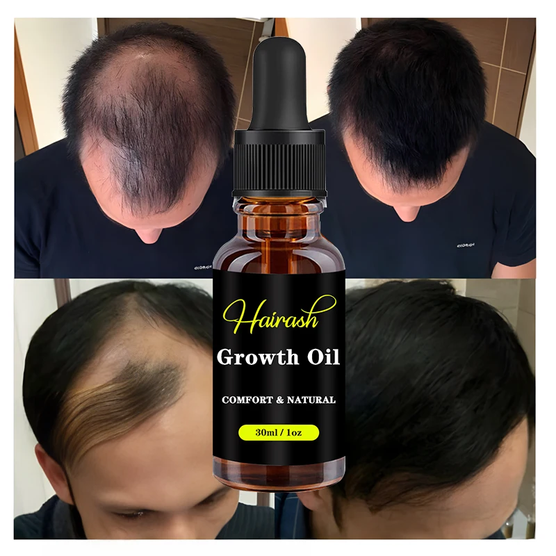 Óleo De Crescimento De Cabelo Para Homens E Mulheres, Tratamento De Perda De Cabelo, Soro De Óleo De Gengibre, Adultos