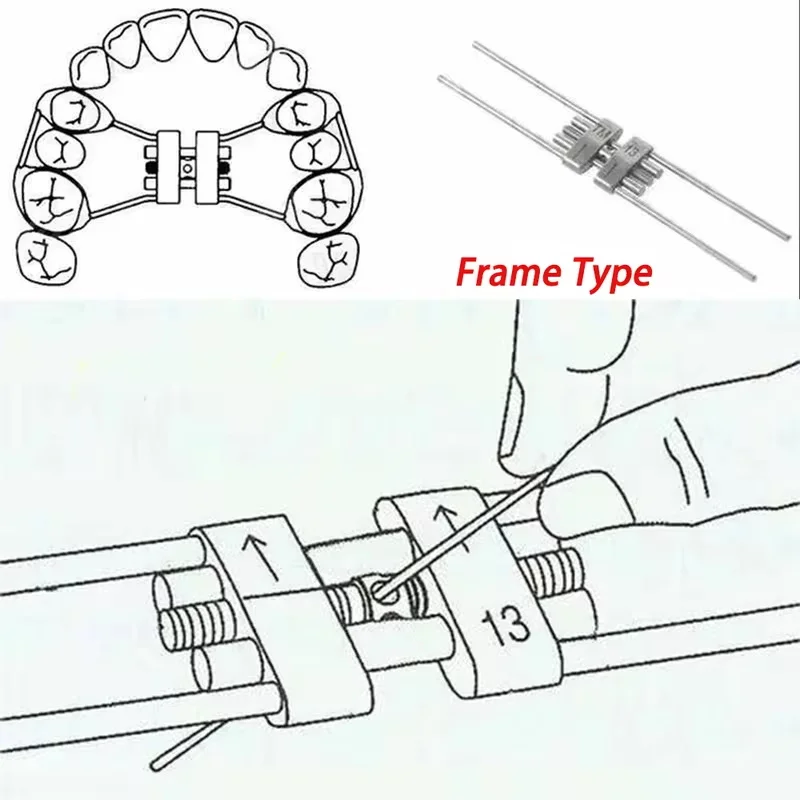 Dental ortodontyczny śruba rozprężna typ ramy stal nierdzewna 8/9/11/13mm szybki ekspander palenny stomatologia narzędzia ortodontyczne materiał