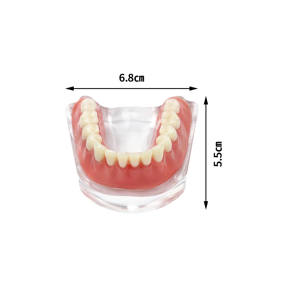 Submaxillary Dental Implant Teeth Model Restoration Bridge Removable Transparent Mandible Overdenture Model For Teaching Display