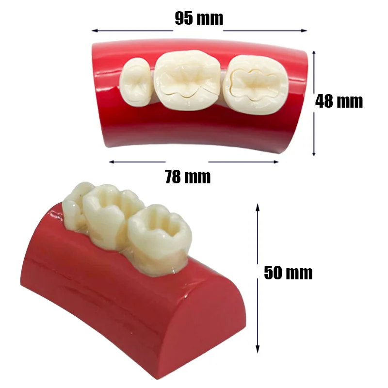 Modèle de remplissage Chevpour dentiste, grande incrustation dentaire, exercice de nuit, matériaux en résine, étude fuchsia