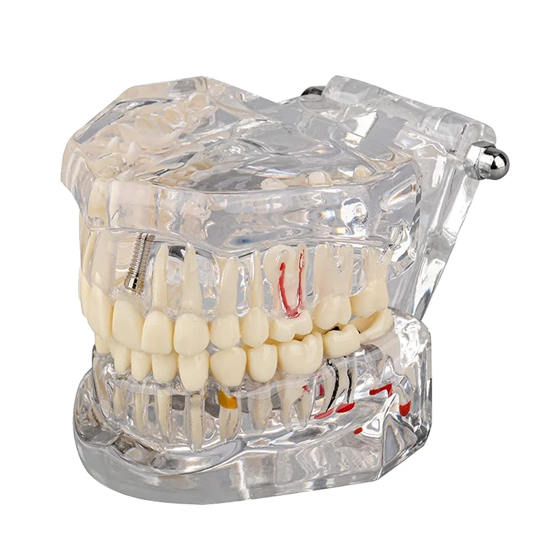 

1 PCS Transparent Disease Teeth Model With Implant Bridge, Transparent Plastic For Patient And Student Education