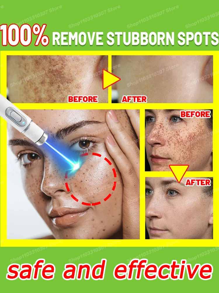 

Blu-ray pen Whitening Facial Spots