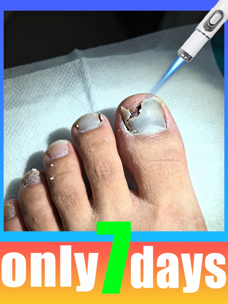 

2025 Second Generation Nail Cleaning Tools Blue Light Laser Say Goodbye to Onychomycosis