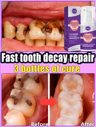 Tooth decay Repair Repairing Cavities  Protecting Anti Caries