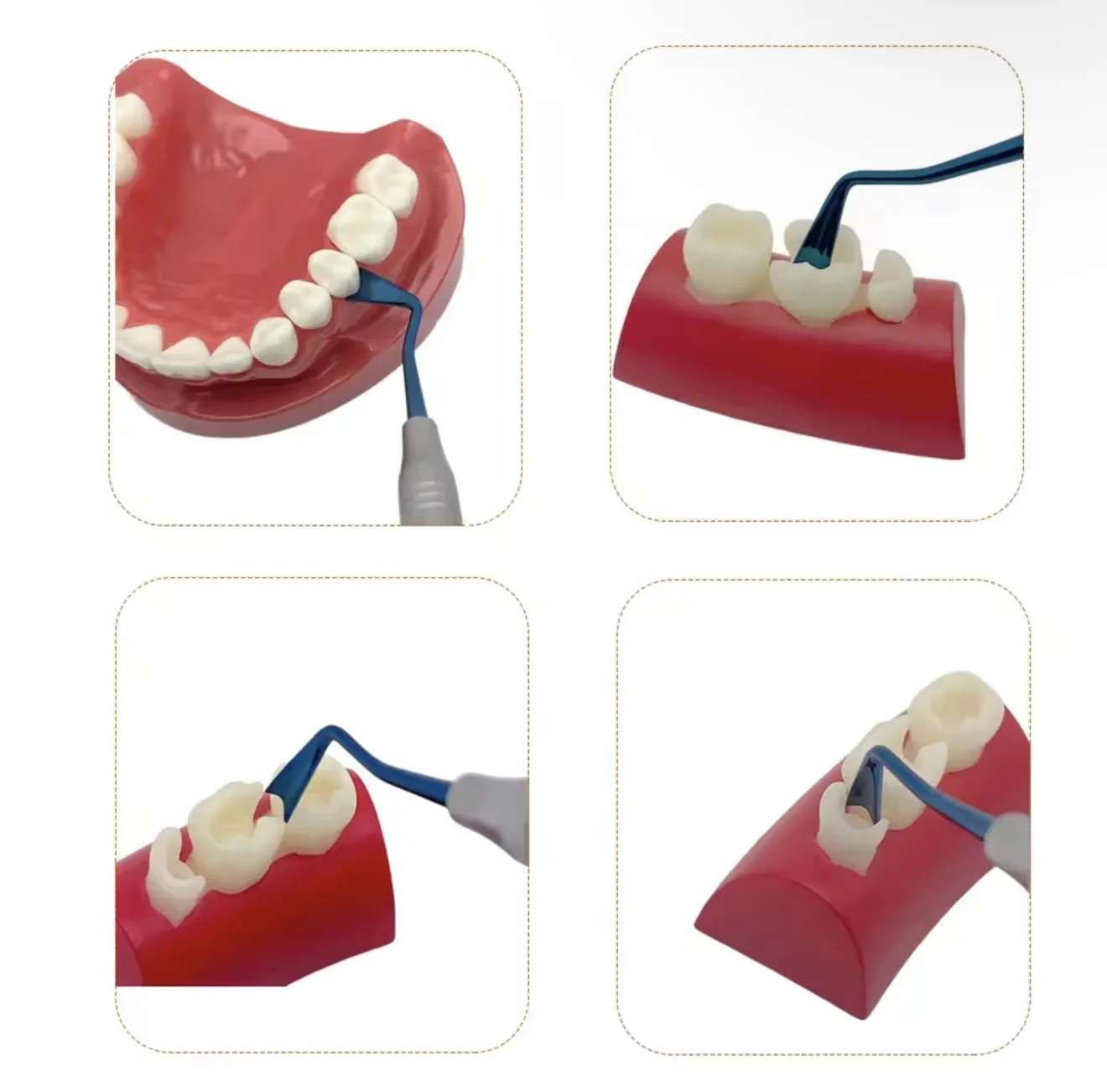 DENILK 3pcs/set  Dental Gingival Retraction Tool, Implant Gum Separator for Surgical Isolation, Durable & Ergonomic Design