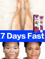 Vitiligo Ointment Effectively Improvement White Spot Skin Eliminate