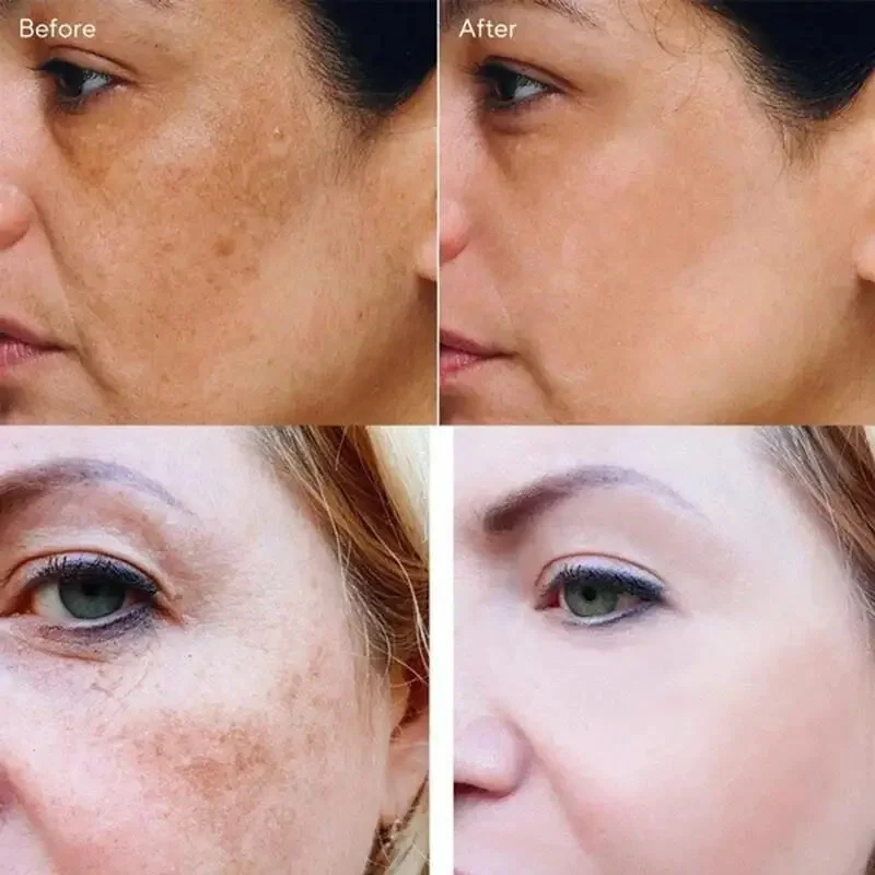 Whitening Sproeten Gezichtscrème Vitamine C Verwijderen Melasma Donkere Vlekken Crème Fade Melanine Hydrateren Helderder Gladde Schoonheid Huidverzorging