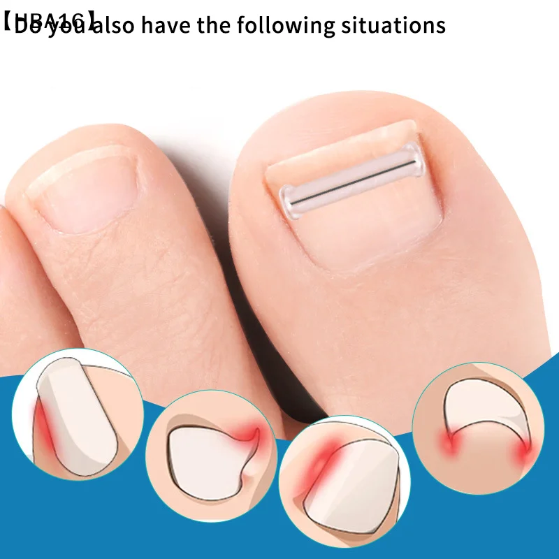 ómHBA16 Parque2 Stuks Nagel Correctie Stickers Ingegroeide Teennagel Corrector Patches Paronychia Behandeling Herstellen Corrector Pedicure Gereedschap