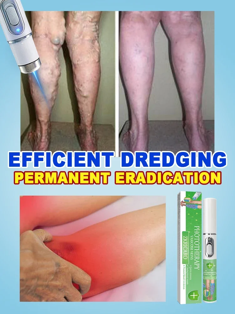 Intravenous laser treatment can improve moderate varicose veins, effectively unclog and permanently eliminate varicose veins