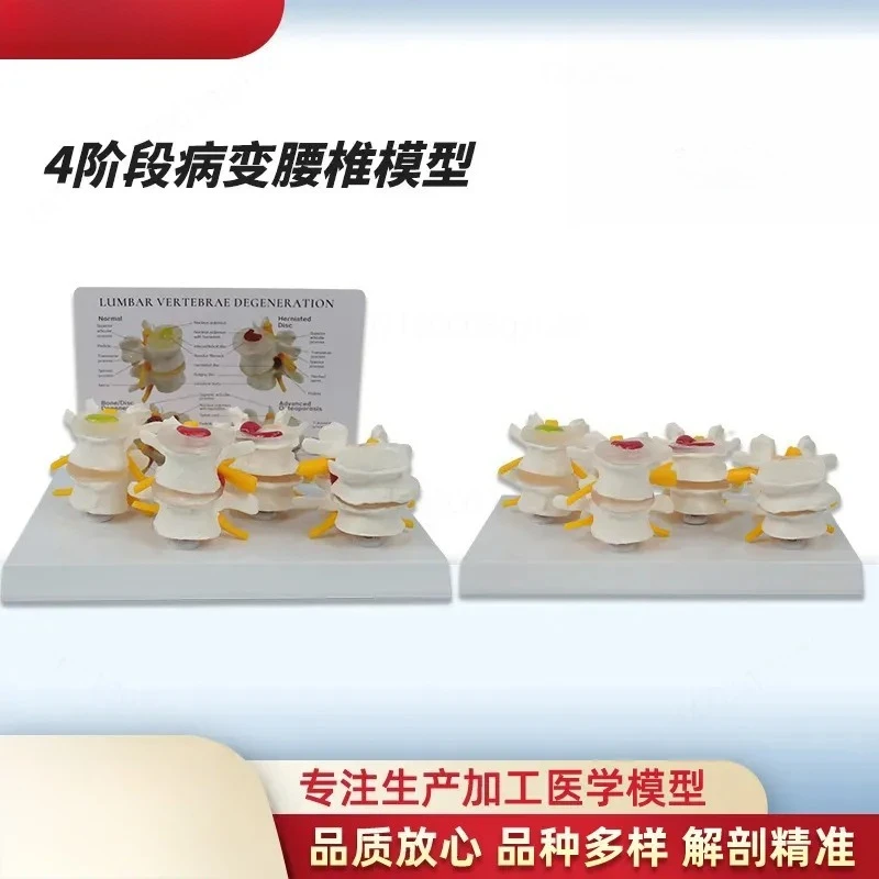 for 4-Stage lesion lumbar spine model orthopedics teaching display aids medical school training anatomy study props
