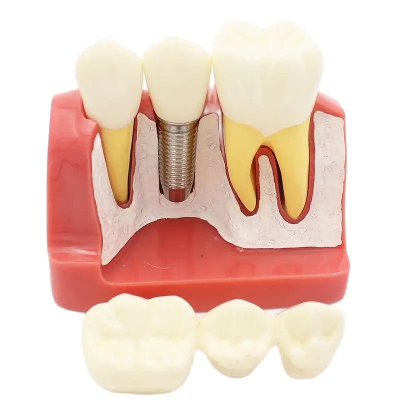 Crown Bridge PerfecModel pour l\'enseignement dentaire, analyse d\'implant dentaire, démonstration dentaire, modèle de dents