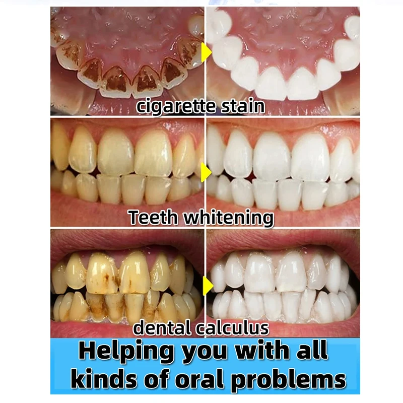 Dentífrico removedor de cálculo dental, remover os dentes amarelos, mau hálito, placa de limpeza, mancha dentária, clareamento, prevenção da periodontite