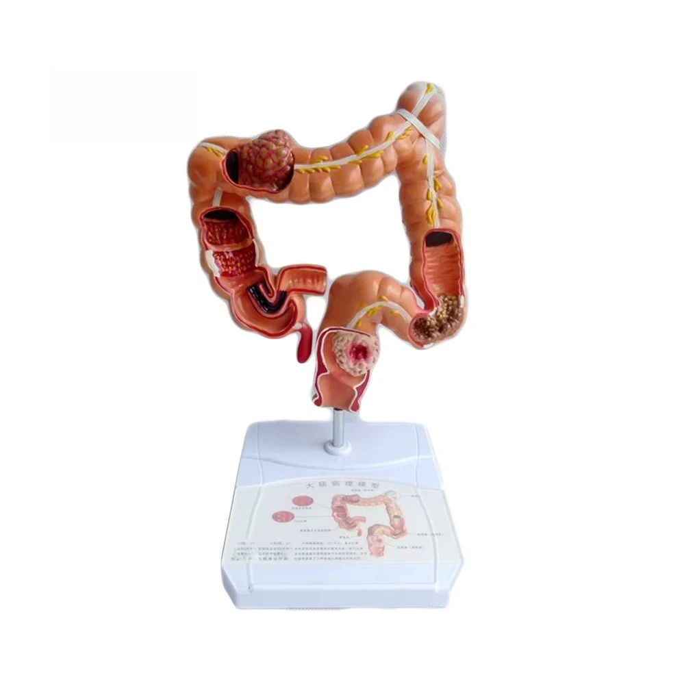 YLC010 Human Colon Pathology Anatomy Model, Medical Teaching Use