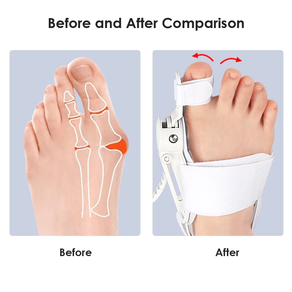 1Pcs Bunion Corrector Orthopedic Toe Straightener, Adjustable Splint Bunion Pads Day Night Support with Toe Separator for Bunion