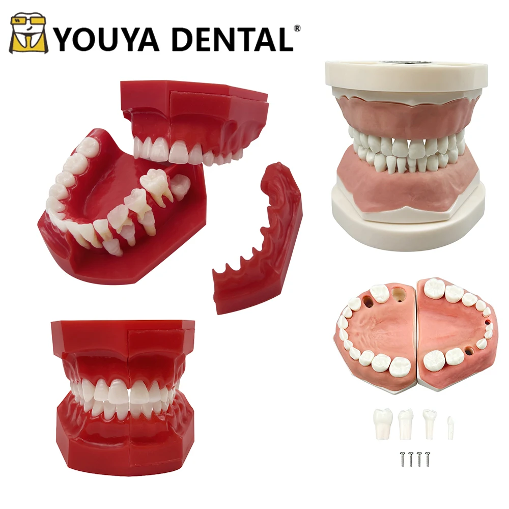 

Child Caries Dental Model Primary Permanent Teeth Alternate Model Replacement Teeth Development Demonstration Model Materials