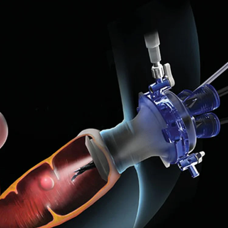 Scarless Surgery Disposable Single Port Multi Channel Trocar for Transanal Access Platforms