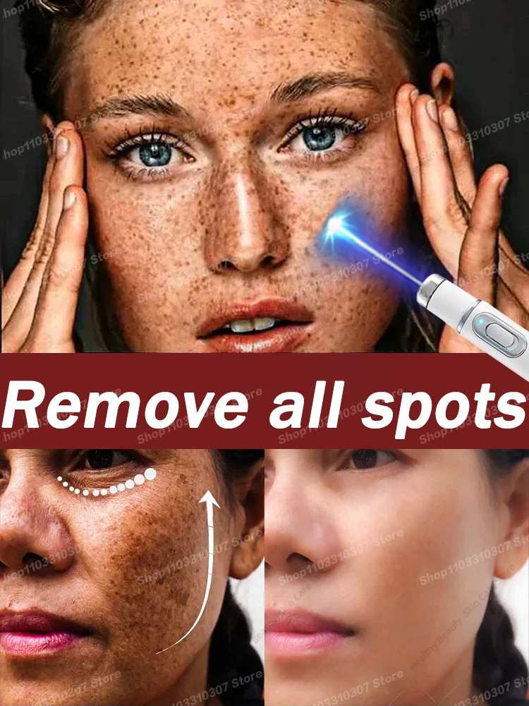 Nano laser Facial Spots are gone