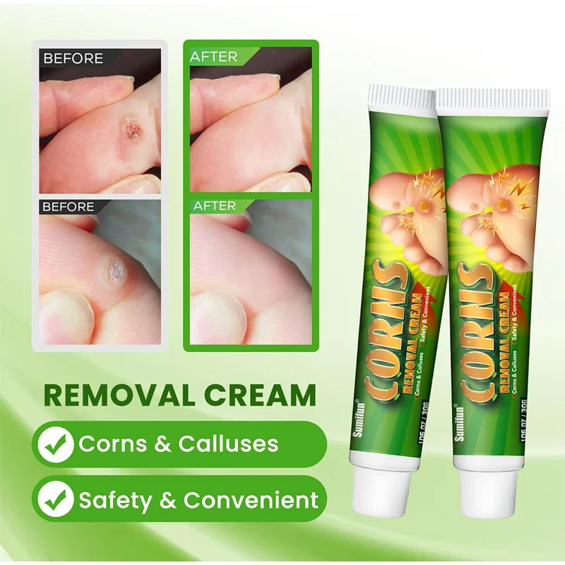 

Foot Corn Remover Cream Chicken Eye Skin Infection Treatment Ointment Feet Dead Skin Calluses Removal Tool Health Care