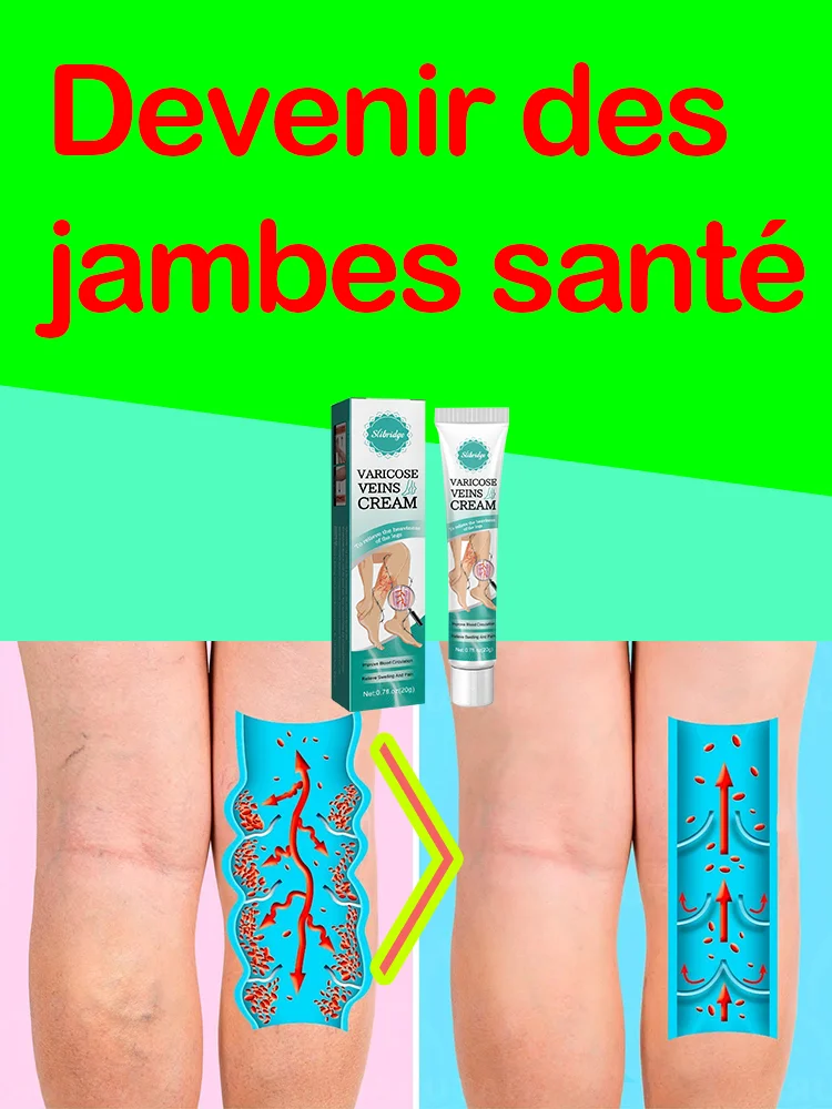 

Effective varicose vein soothing cream. Vasculitis, phlebitis, spider leg soothing cream