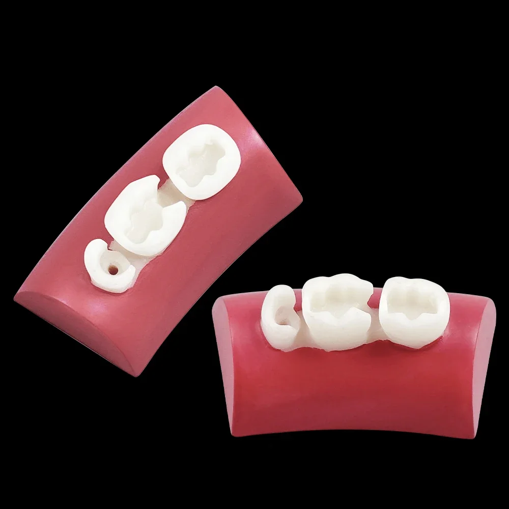 5pcs Dental Practice Filling Teeth Model Resin Filling Inlay Exercise Model Block Root Canal Prep Restoration Simulator Typodont