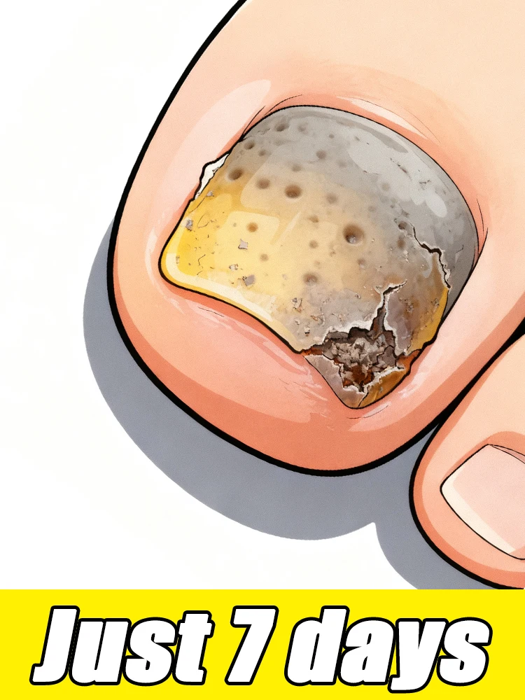 1st 2025  迅速排除白癬（癜風）7日間で問題解決