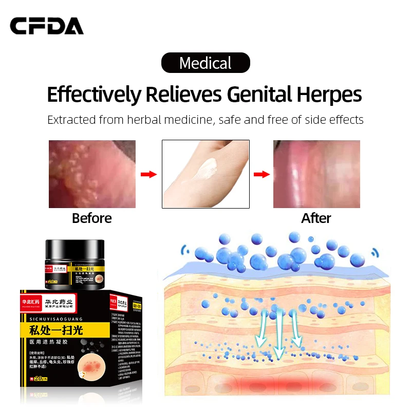 Genital Herpes Treatment Medical Spray Herpes Simplex Cure for Men and Women Shingles Medicine Cream CFDA  Approval 50ml/bottle